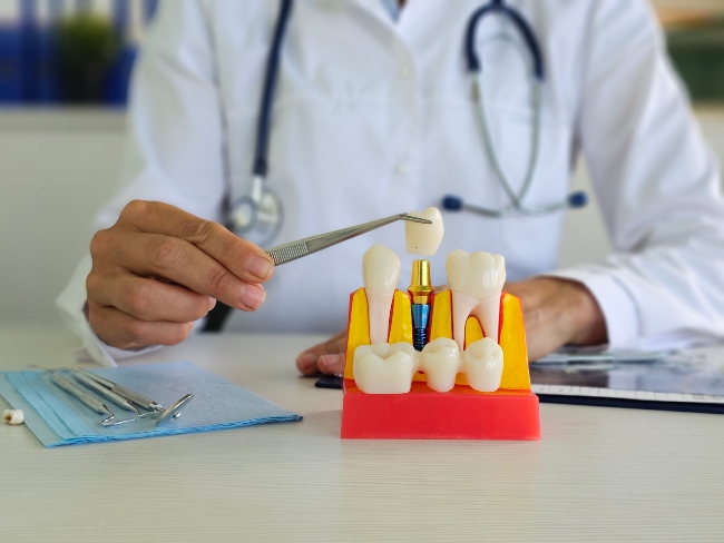 Dentist holding tooth model showing dental implant crown structure in Monett, MO