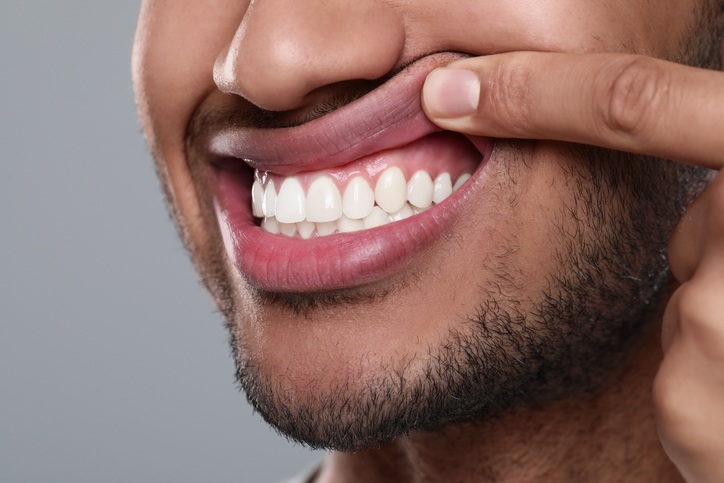 Close-up of healthy teeth and gums, oral hygiene check in Monett, MO